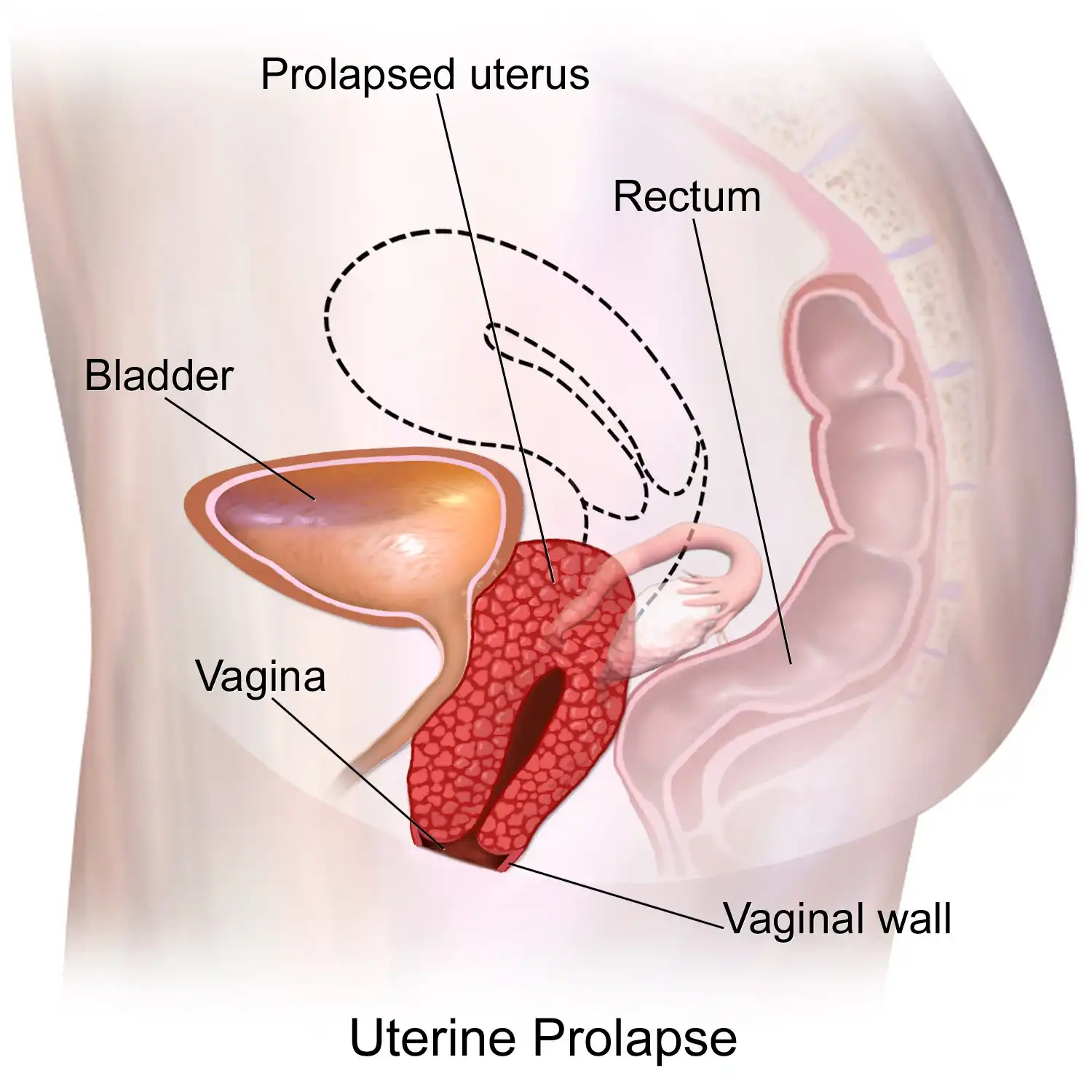Prolaps Uteri (Turun Berok) - Gejala, Penyebab, & Cara Mengatasinya