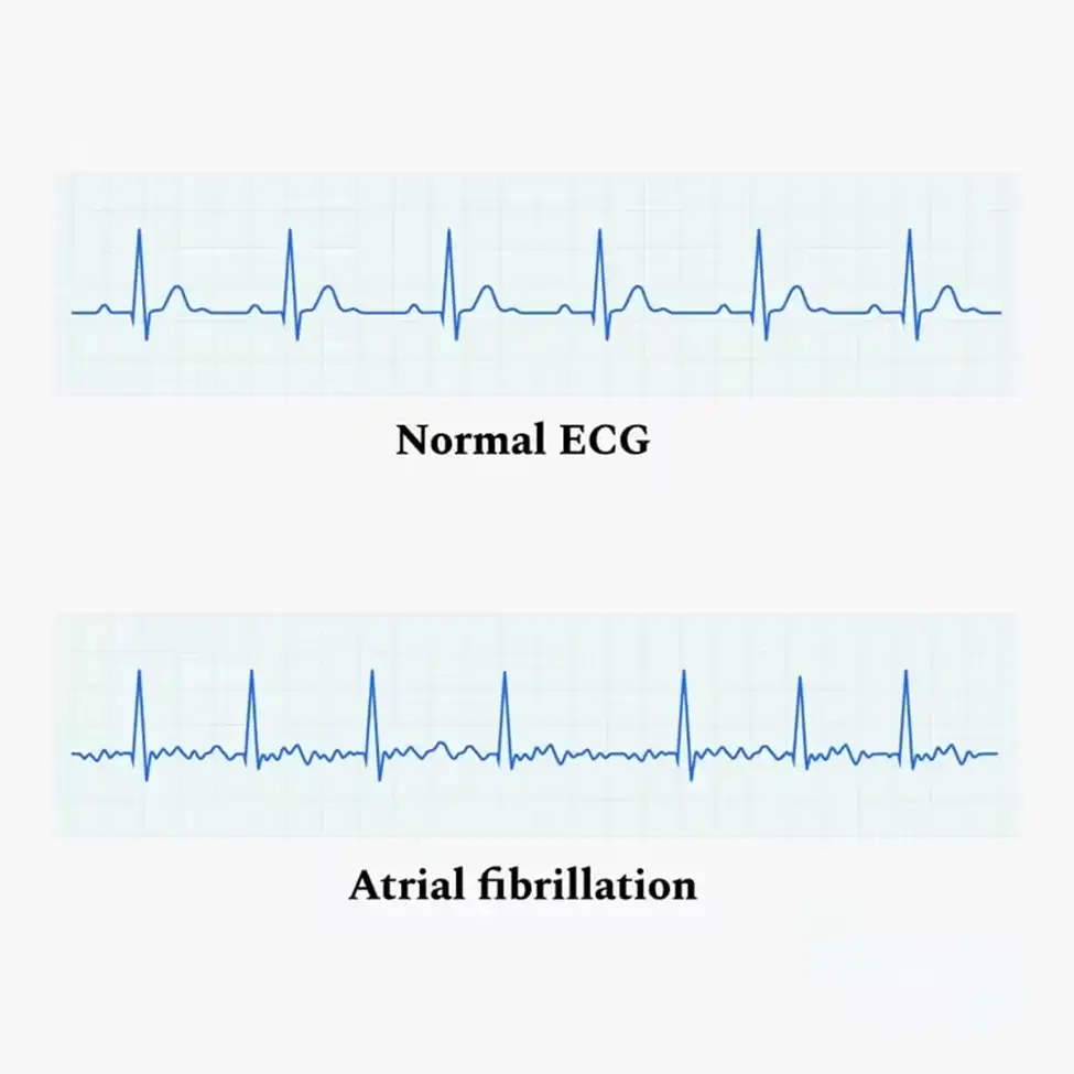 Apa Itu Atrial Fibrilasi? Gejala dan Cara Mengatasinya dengan PFA!