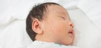 Biduran pada Anak: Ciri-ciri, Penyebab, dan Cara Mengatasinya