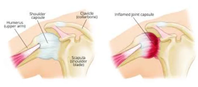 Frozen Shoulder: Penyebab, Gejala, & Pengobatannya!