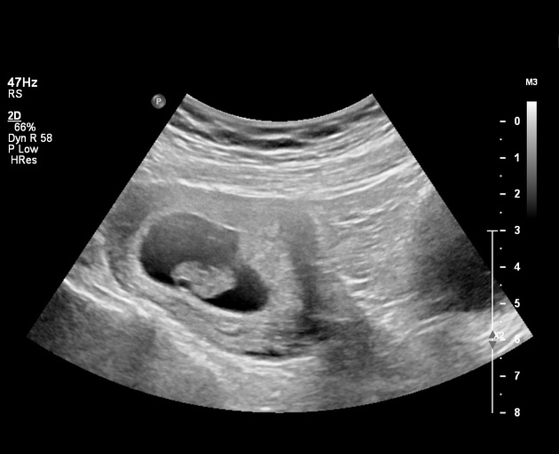 15 Ciri-Ciri Janin Sehat pada Trimester Pertama, Catat Bunda!