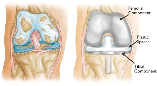 Total Knee Replacement: Prosedur, Risiko, & Biaya Operasi