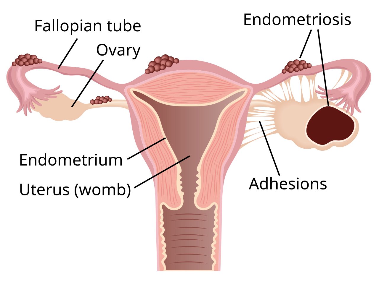 Endometriosis Adalah: Gejala, Penyebab, dan Cara Mengobatinya
