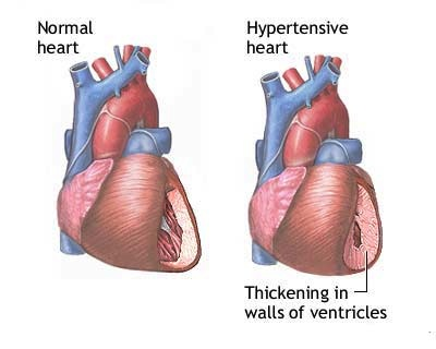 Penyakit Jantung Hipertensi/Hypertensive Heart Disease: Tanda, Penyebab, Diagnosis & Pengobatan