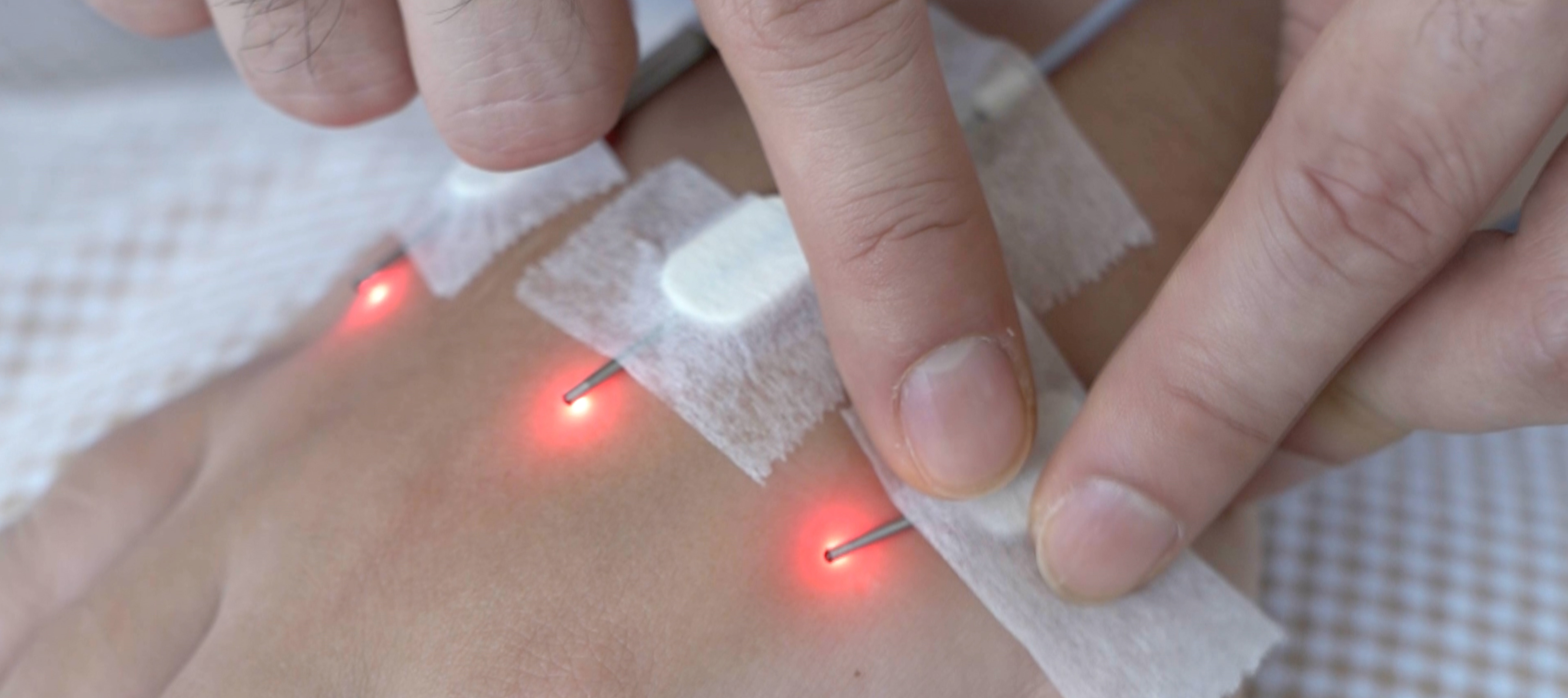 Pain-Free Solution with Electroacupuncture