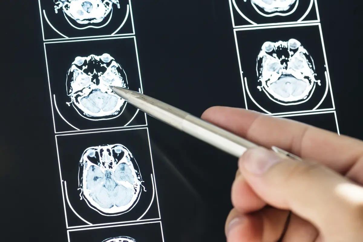 Tumor Otak: Penyebab, Faktor, Gejala, & Cara Mencegahnya