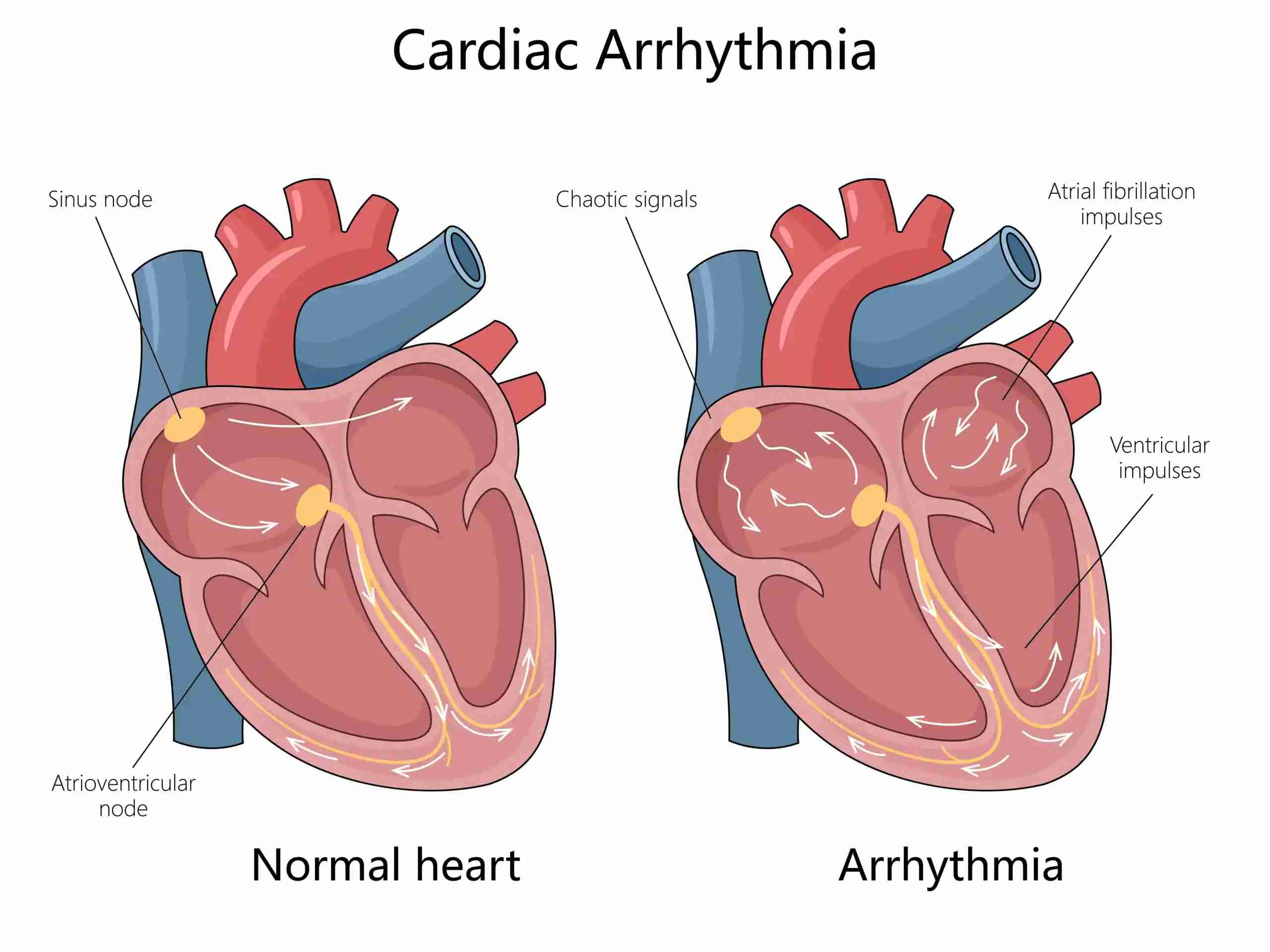 Aritmia Jantung: Gejala, Diagnosis, Penyebab, & Pencegahannya