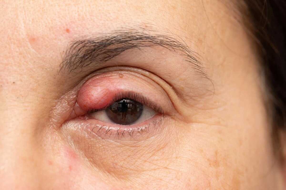 Tumor Kelopak Mata: Gejala, Penyebab, dan Cara Mengobatinya