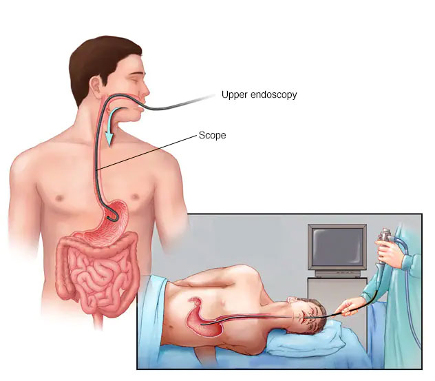 Endoskopi Lambung: Arti, Prosedur, & Biaya Operasinya