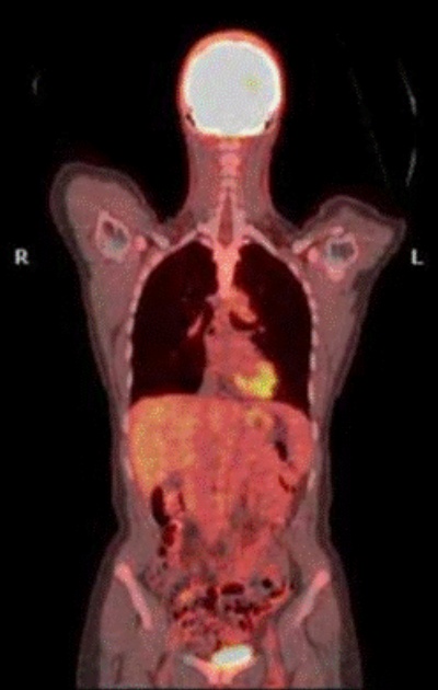 PET Scan: Kenali Arti, Prosedur, Biaya, & Risikonya
