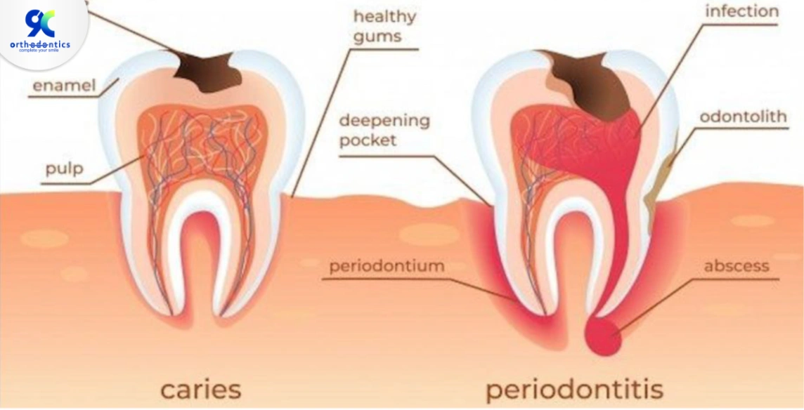 12 Cara Mengatasi Gigi Berlubang & Gejalanya, Ampuh dan Aman!