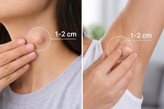 Jangan Abaikan Jika Muncul Benjolan : Waspadai Kelenjar Getah Bening