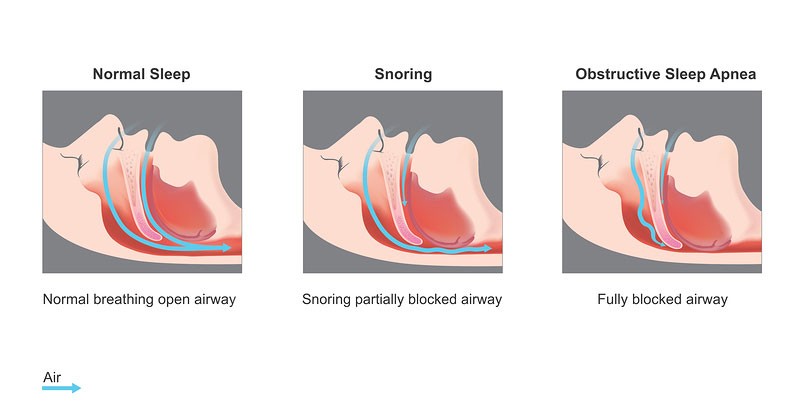 Obstructive Sleep Apnea (OSA): Gangguan Tidur yang Diam-Diam
