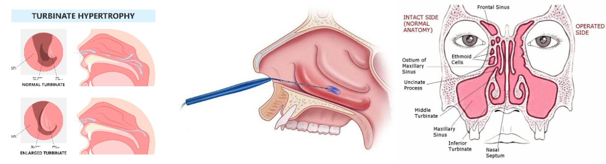 Reduksi Konka dengan Radiofrekuensi: Solusi Modern untuk Hidung Tersumbat Tanpa Operasi Besar