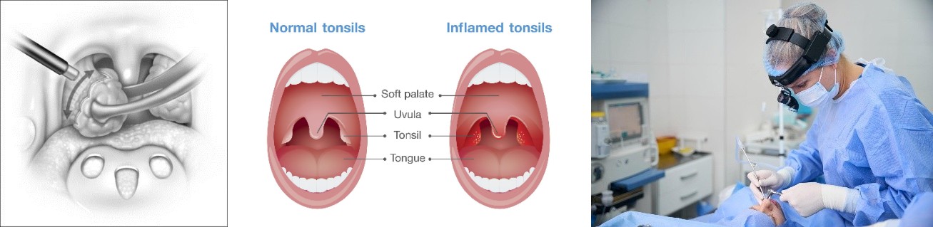 Tonsilektomi dengan Radiofrekuensi: Solusi Modern, Minim Nyeri untuk Operasi Amandel