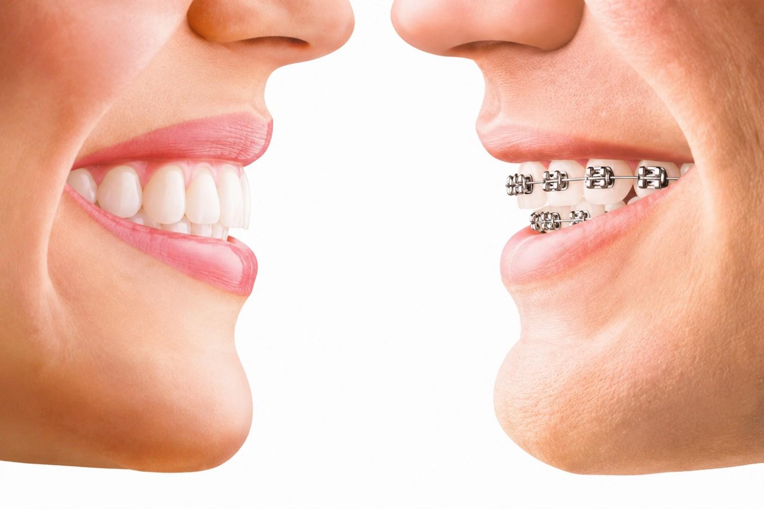 Aligners atau Braces: Mana yang Lebih Cocok untuk Merapikan Gigi?