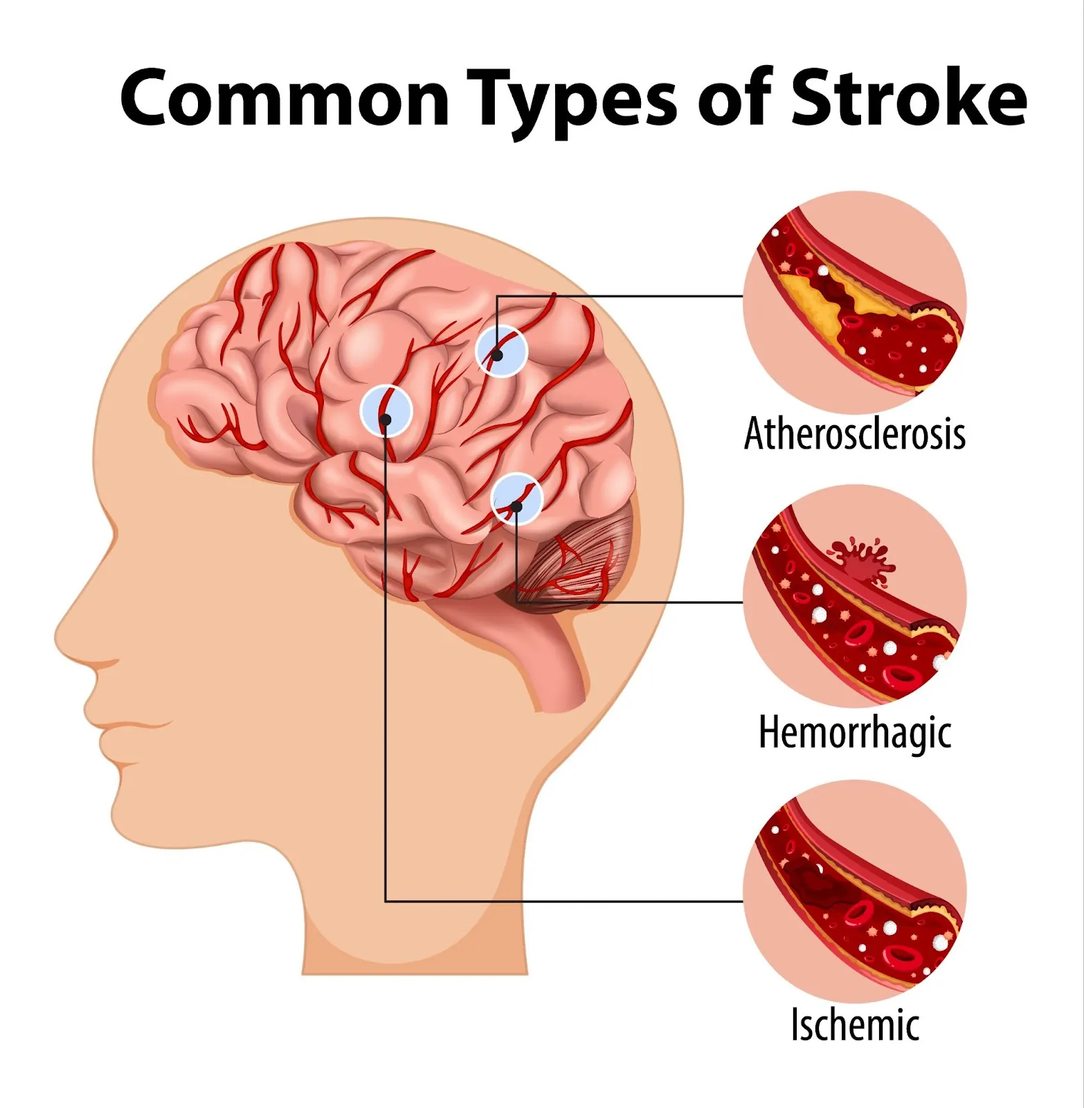 Stroke Iskemik (Penyumbatan) – Penyebab, Tanda & Bisakah Sembuh?