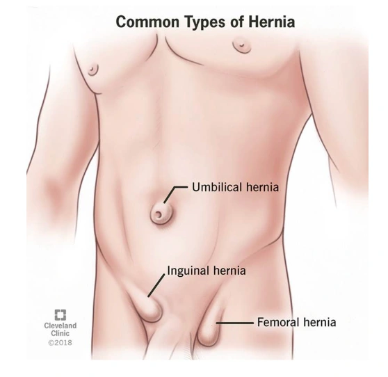 Hernia: Waspadai Gejalanya & Kenali 3 Cara Pengobatannya