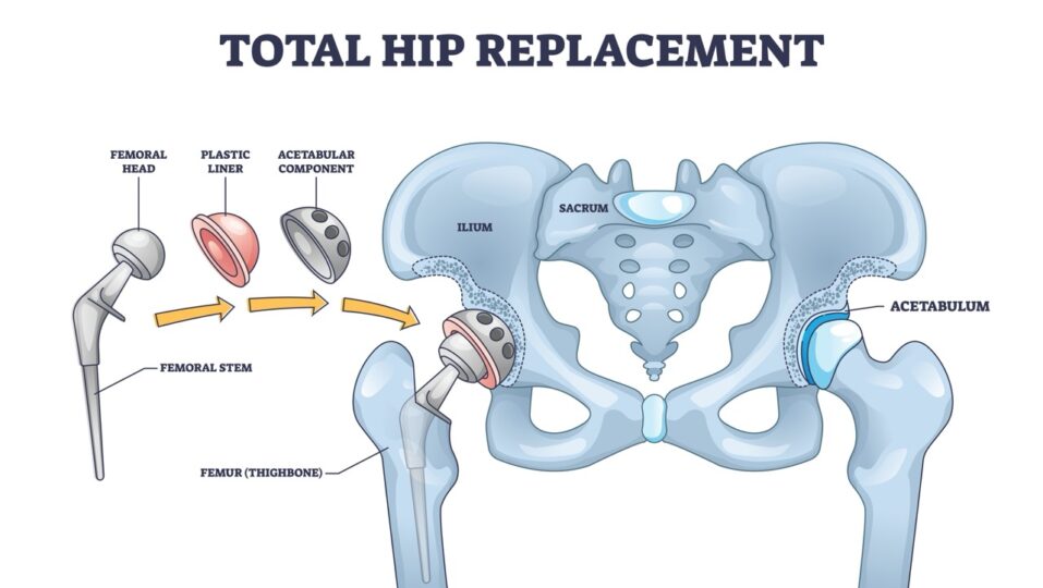 Total Hip Replacement: Prosedur, Biaya, Risiko, dan Pemulihannya