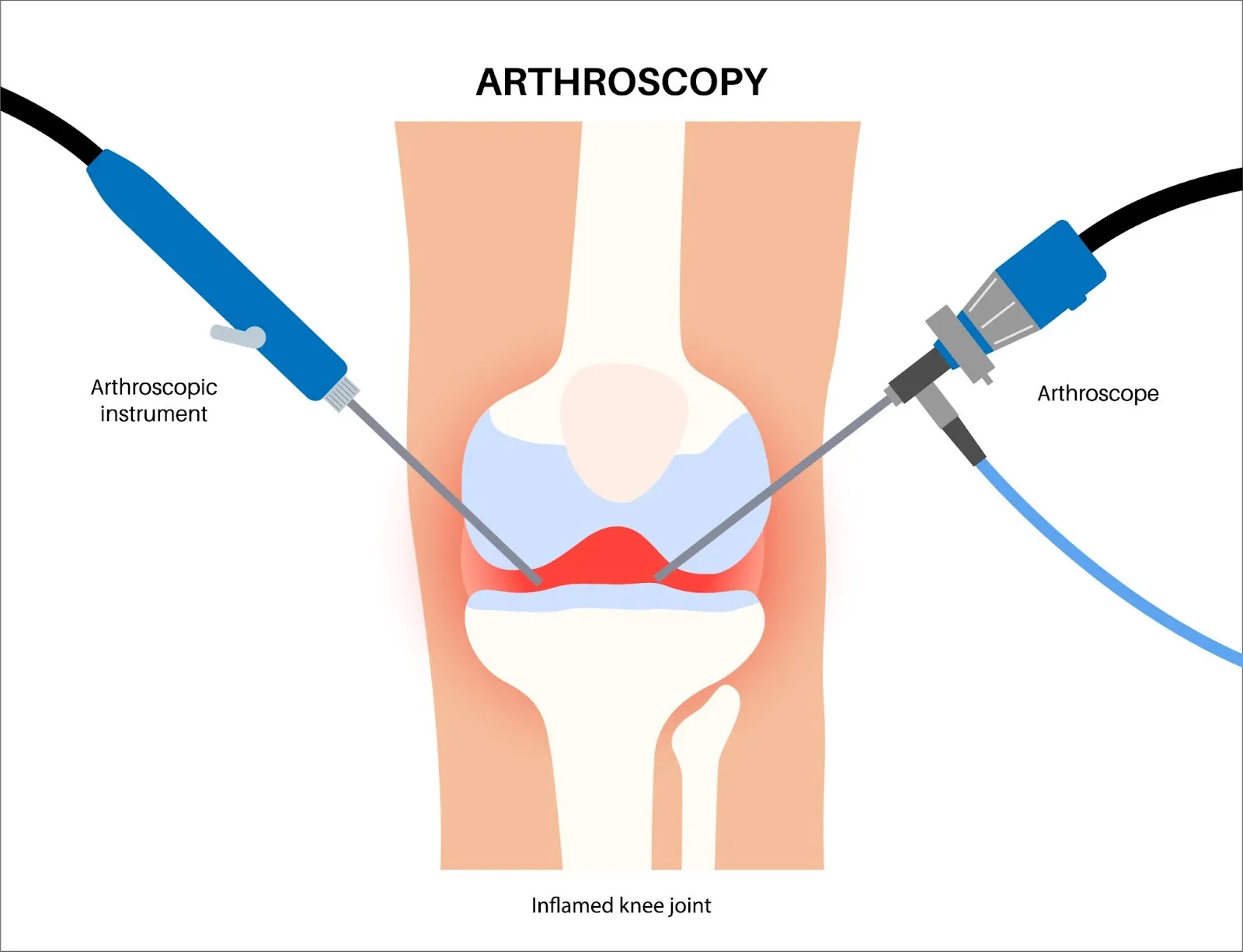 Operasi Lutut Osteoarthritis (OA) – Prosedur, Biaya, & Kapan Diperlukan?