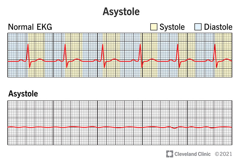 EKG Asistol (Garis Datar) – Penyebab, Ciri & Langkah yang Dilakukan