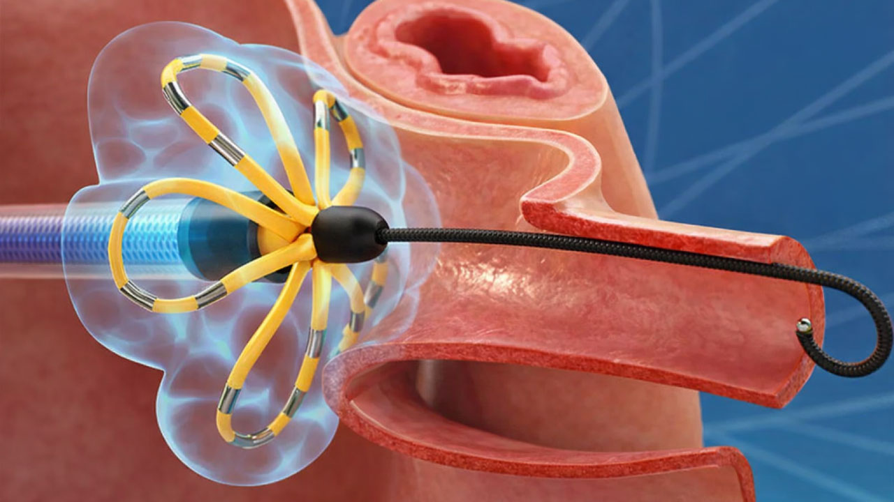Pulihkan Irama Jantung Lebih Aman dengan Pulsed Field Ablation (PFA) dan teknologi 3 dimensi (3D) di Tzu Chi Hospital