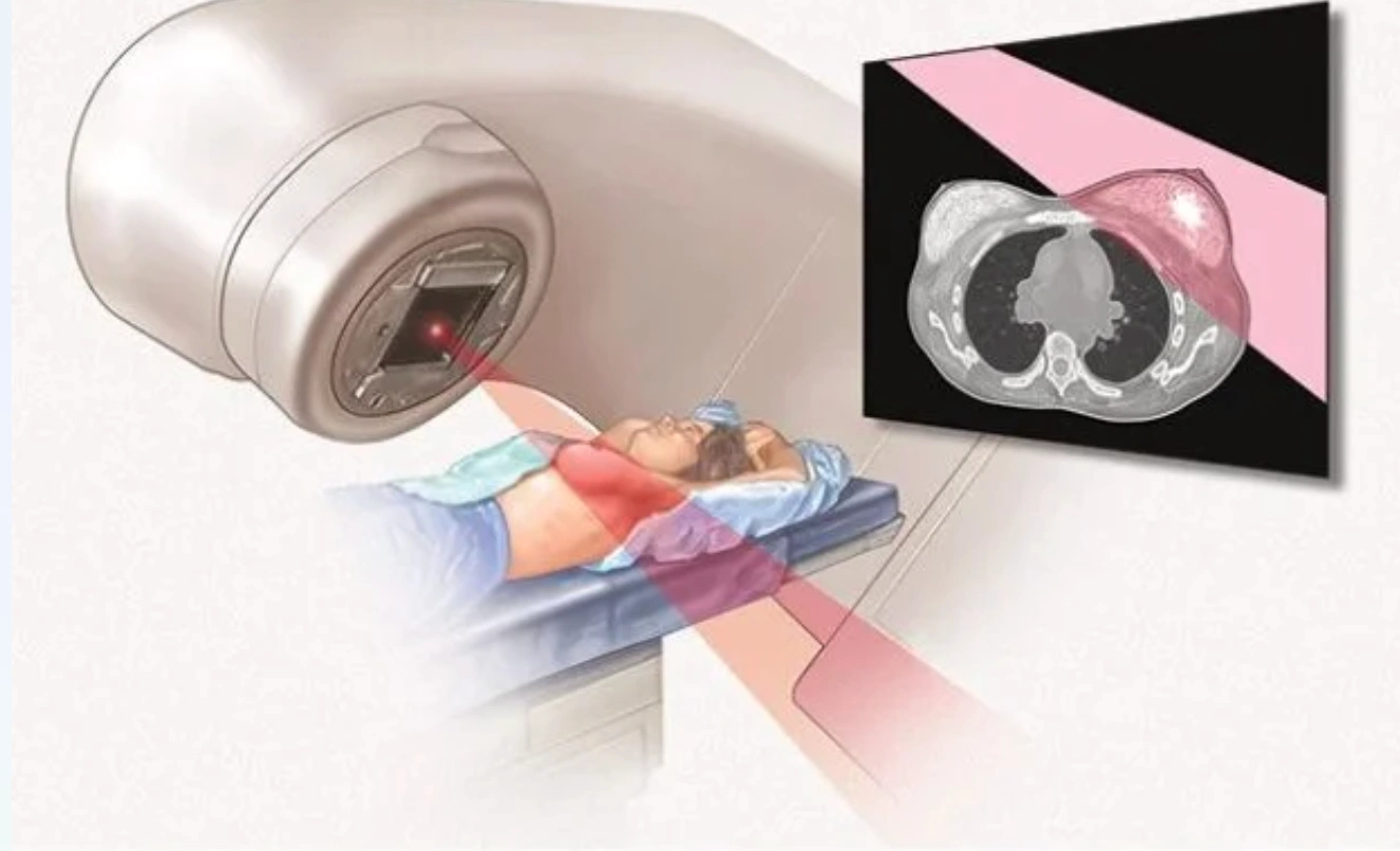 Radioterapi Kanker Payudara: Prosedur, Efek Samping, dan Tips Mengatasinya
