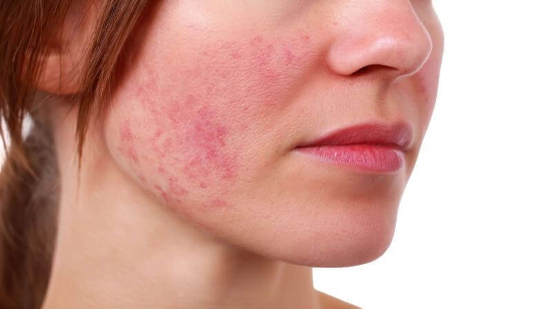 Lupus Adalah: Penyebab, Gejala, Jenis, dan Cara Mengobatinya
